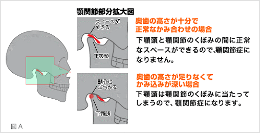 顎関節症